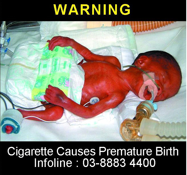 Malaysia 2008 ETS Baby - premature birth, lived experience, baby with oxygen tubes (back)